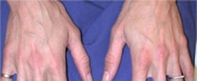 Hand Rejuvenation Before & After Gallery - Patient 5930300 - Image 1