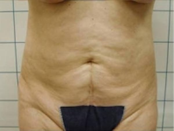 SmartLipo Before & After Gallery - Patient 5930292 - Image 4