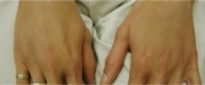 Hand Rejuvenation before and after photos