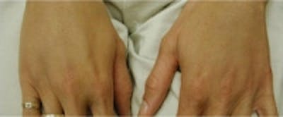 Hand Rejuvenation Before & After Gallery - Patient 5930300 - Image 2