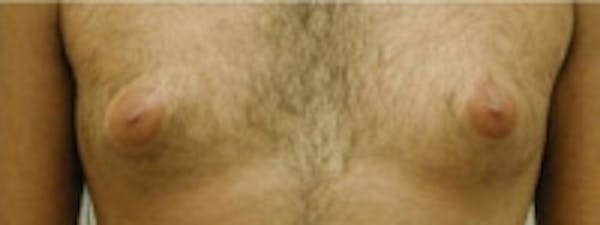 SmartLipo Before & After Gallery - Patient 5930301 - Image 1