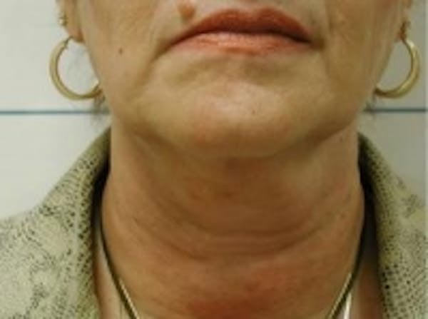 Liposuction Before & After Gallery - Patient 5930303 - Image 2