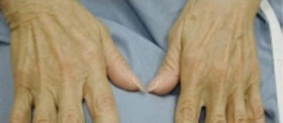 Hand Rejuvenation Before & After Gallery - Patient 5930302 - Image 1