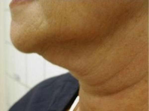 Liposuction Before & After Gallery - Patient 5930303 - Image 3