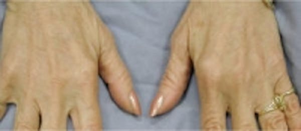 Hand Rejuvenation Before & After Gallery - Patient 5930302 - Image 2