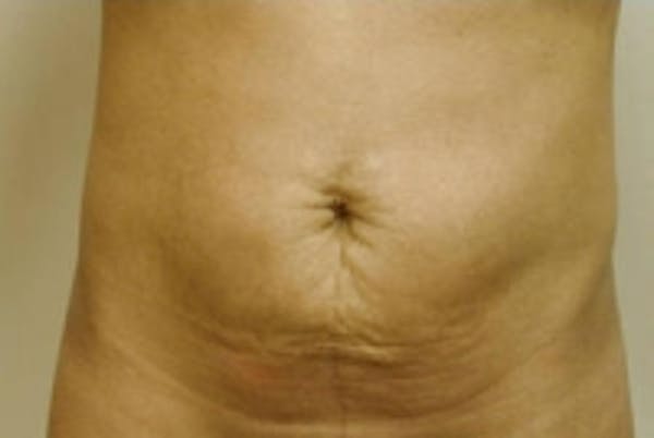 SmartLipo Before & After Gallery - Patient 5930304 - Image 1