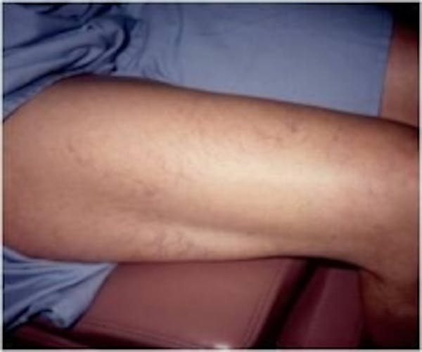 Spider Veins Before & After Gallery - Patient 5930326 - Image 1