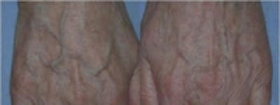 Hand Rejuvenation Before & After Gallery - Patient 5930325 - Image 1