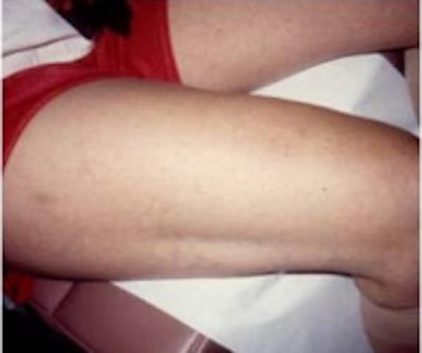 Spider Veins Before & After Gallery - Patient 5930326 - Image 2