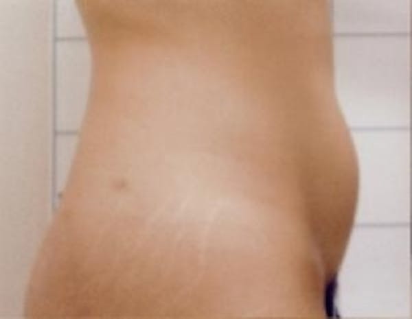 SmartLipo Before & After Gallery - Patient 5930327 - Image 1
