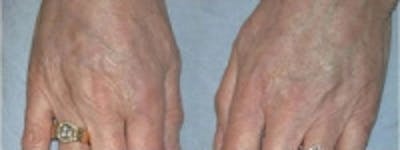 Hand Rejuvenation Before & After Gallery - Patient 5930325 - Image 2