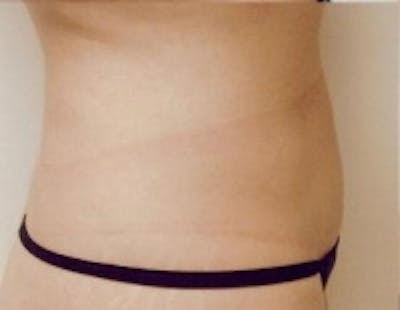 SmartLipo Before & After Gallery - Patient 5930327 - Image 2