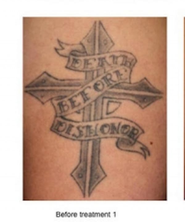 Tattoo Removal Before & After Gallery - Patient 5930328 - Image 1