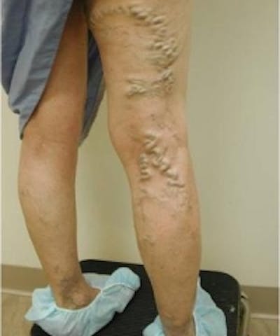 Spider Veins Before & After Gallery - Patient 5930330 - Image 1