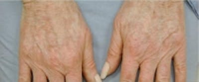 Hand Rejuvenation Before & After Gallery - Patient 5930329 - Image 1
