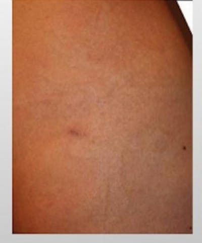 Tattoo Removal Before & After Gallery - Patient 5930328 - Image 2