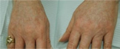 Hand Rejuvenation Before & After Gallery - Patient 5930329 - Image 2