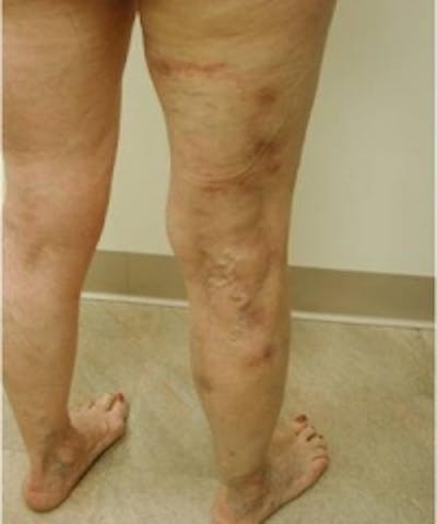 Spider Veins Before & After Gallery - Patient 5930330 - Image 2