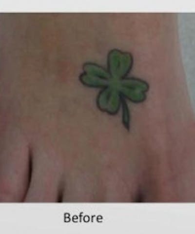Tattoo Removal Before & After Gallery - Patient 5930332 - Image 1