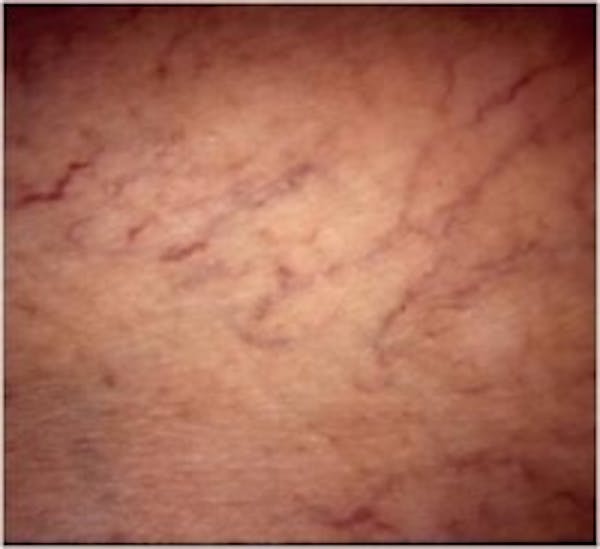 Spider Veins Before & After Gallery - Patient 5930333 - Image 1