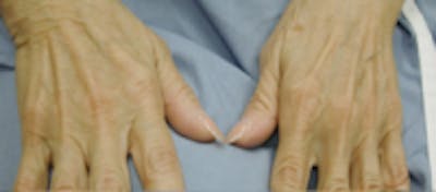 Hand Rejuvenation Before & After Gallery - Patient 5930334 - Image 1