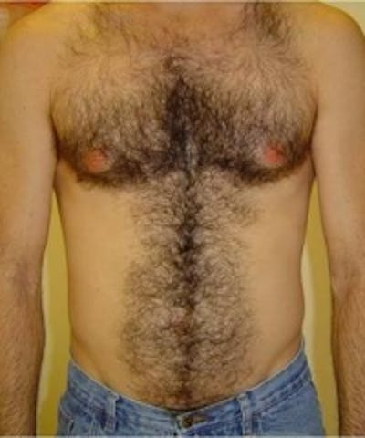 Laser Hair Removal Gallery - Patient 5930335 - Image 1