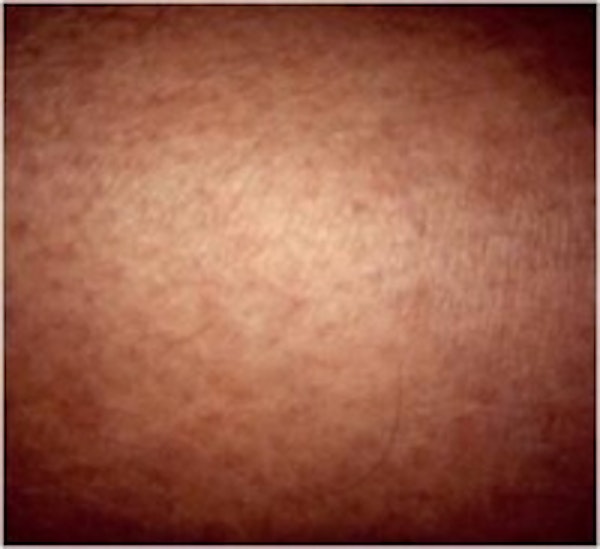 Spider Vein Treatment