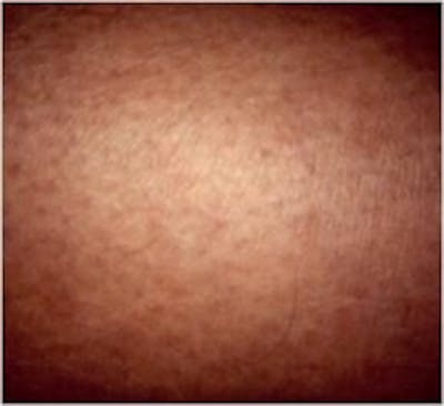Spider Veins Before & After Gallery - Patient 5930333 - Image 2