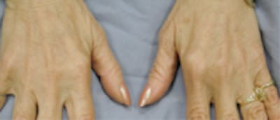 Hand Rejuvenation Before & After Gallery - Patient 5930334 - Image 2
