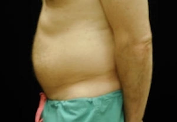 SmartLipo Before & After Gallery - Patient 5930336 - Image 1