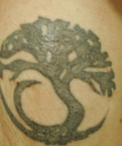 Tattoo Removal Before & After Gallery - Patient 5930339 - Image 1