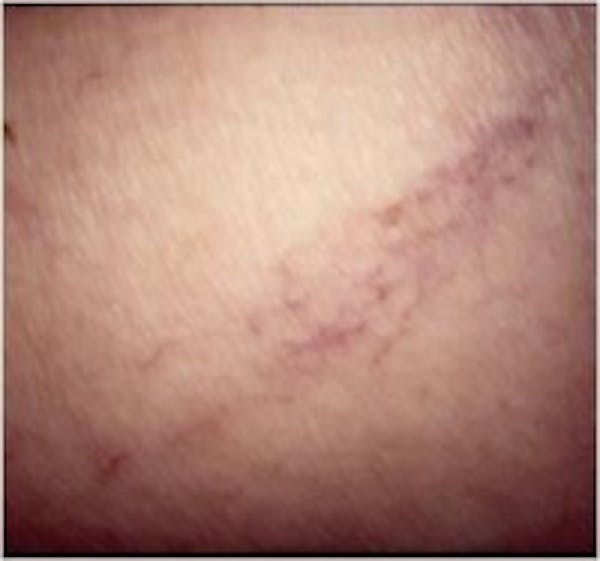 Spider Veins Before & After Gallery - Patient 5930338 - Image 1