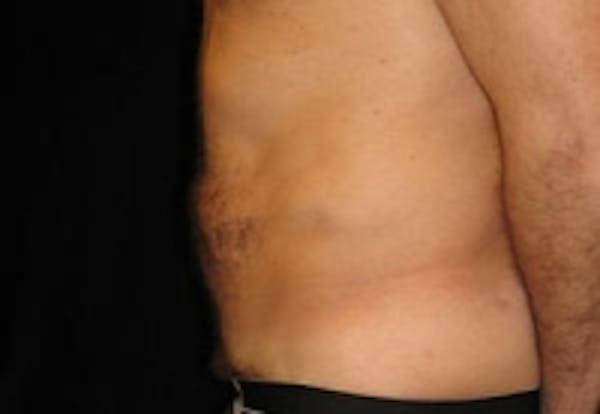 SmartLipo Before & After Gallery - Patient 5930336 - Image 2