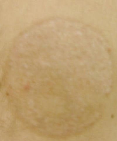 Tattoo Removal Before & After Gallery - Patient 5930339 - Image 2