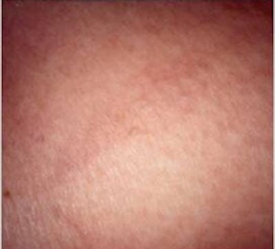 Spider Veins Before & After Gallery - Patient 5930338 - Image 2