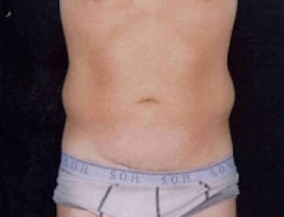 SmartLipo Before & After Gallery - Patient 5930340 - Image 1