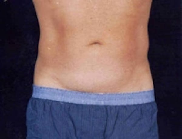 SmartLipo Before & After Gallery - Patient 5930340 - Image 2