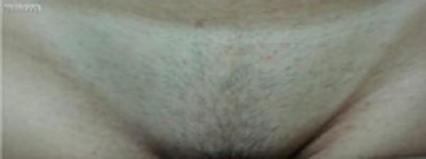 Laser Hair Removal Before & After Gallery - Patient 5930341 - Image 1