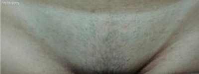 Laser Hair Removal Before & After Gallery - Patient 5930341 - Image 1