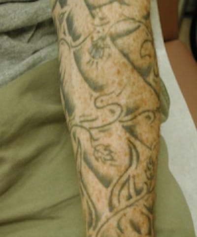 Tattoo Removal Before & After Gallery - Patient 5930345 - Image 1