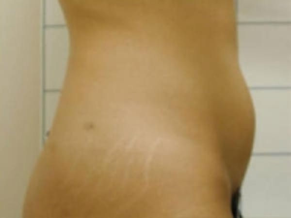 SmartLipo Before & After Gallery - Patient 5930348 - Image 1