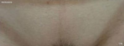 Laser Hair Removal Before & After Gallery - Patient 5930341 - Image 2