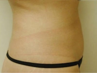 SmartLipo Before & After Gallery - Patient 5930348 - Image 2