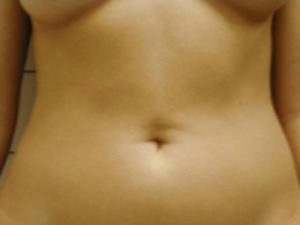 SmartLipo Before & After Gallery - Patient 5930348 - Image 3