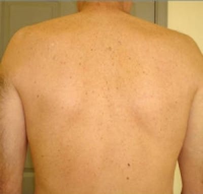 Laser Hair Removal Before & After Gallery - Patient 5930349 - Image 2
