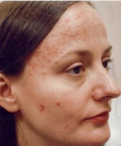 Acne & Rosacea Before & After Gallery - Patient 5930353 - Image 1