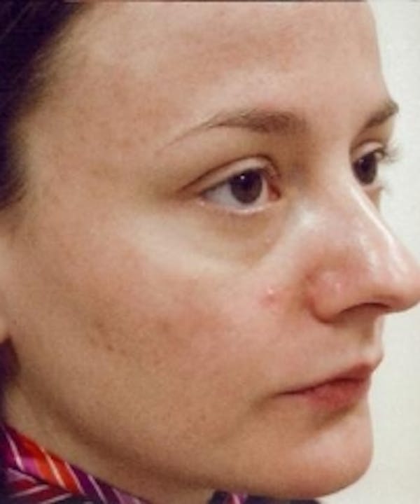 Acne & Rosacea Before & After Gallery - Patient 5930353 - Image 2