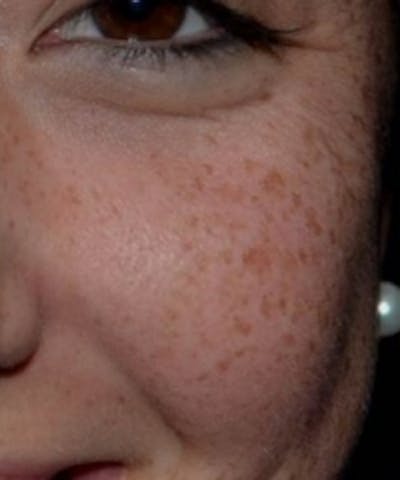 Melasma Before & After Gallery - Patient 5930357 - Image 1