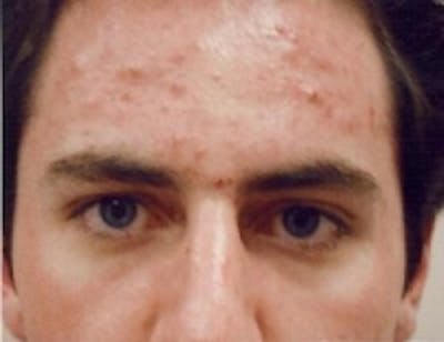 Acne & Rosacea Before & After Gallery - Patient 5930356 - Image 1
