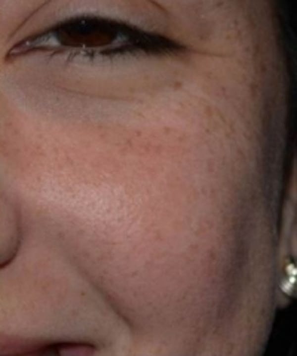 Melasma Before & After Gallery - Patient 5930357 - Image 2